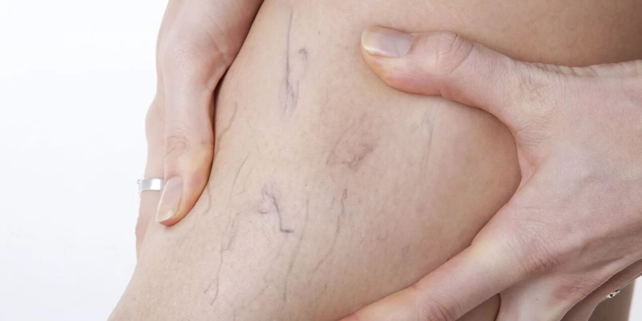 Before using Varicon cream