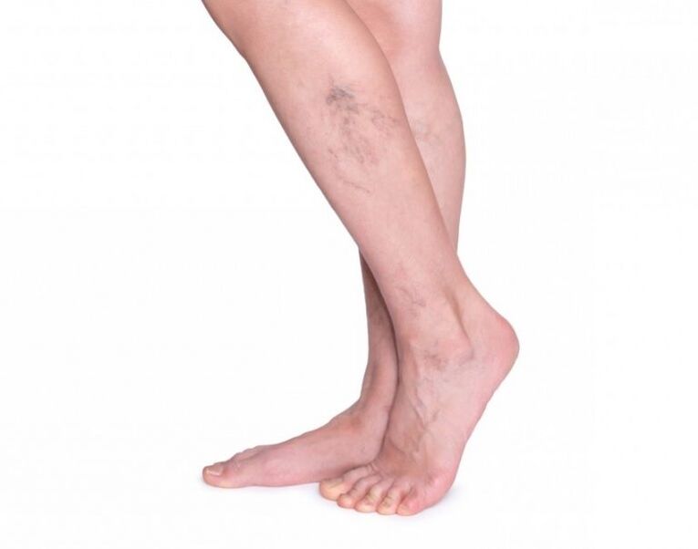 Varicose veins in front of treatment varicon