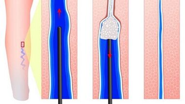Sclerotherapy at varicose veins
