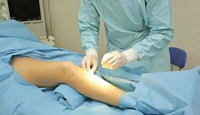 How a company is carried out with varicose veins