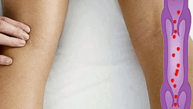 The reasons for the development of varicose veins of the lower extremities