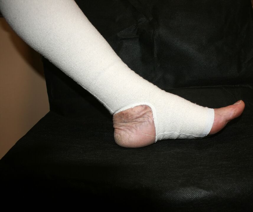 Print knitting clothes for varicose veins