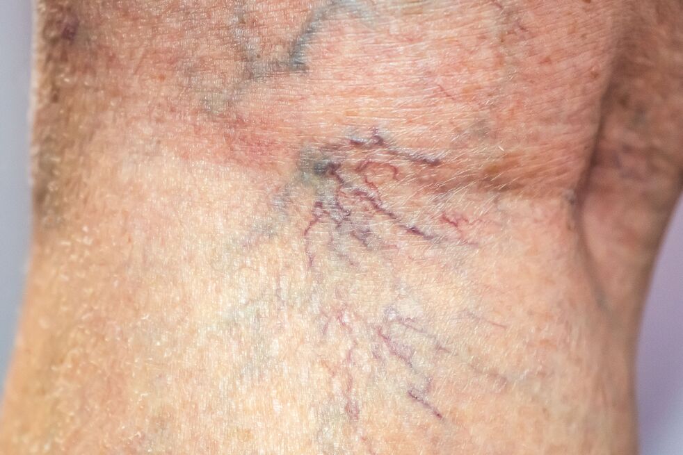 Varicose veins